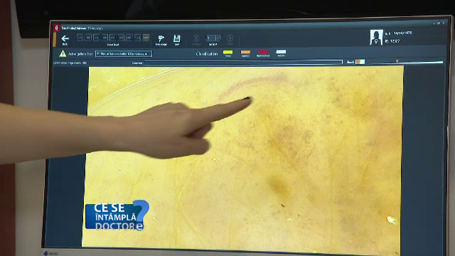 De ce trebuie sa va feriti de soare daca sunteti predispusi alergiilor. Legatura dintre vitamina D si uscarea pielii