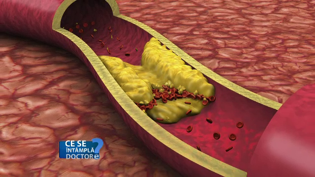 Trigliceridele marite, la fel de daunatoare pentru sanatate precum colesterolul. Ce boala periculoasa pot declansa