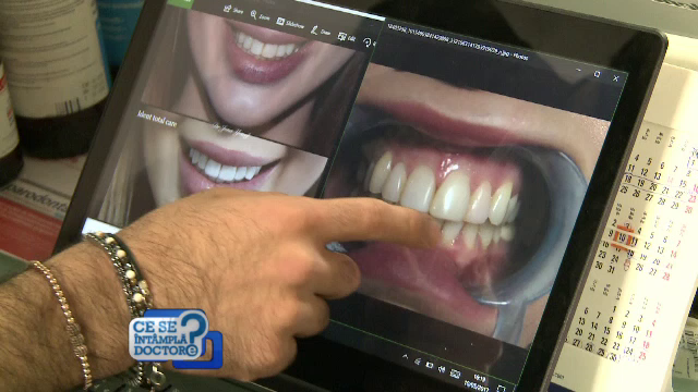 Xonia si-a schimbat look-ul si a inceput cu smaltul dintilor. Sfaturile stomatologilor pentru a evita parodontoza