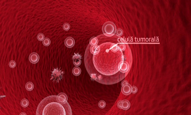 Terapia revolutionara care face minuni in tratarea cancerului. In Romania nu se foloseste, iar "afara" costa 500.000 dolari