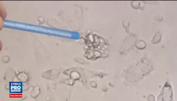 Terapia revolutionara care face minuni in tratarea cancerului. In Romania nu se foloseste, iar afara costa 500.000 dolari