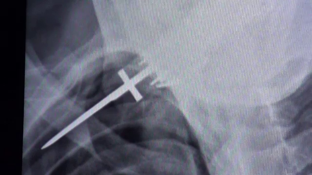 Un barbat din judetul Botosani a fost injunghiat de un necunoscut dupa ce a iesit la poarta. Victima, operata de urgenta