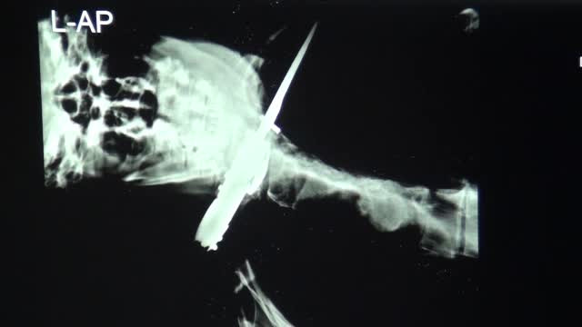 Un sucevean a mers la spital si a spus ca a fost injunghiat de un necunoscut. Cine il atacase de fapt