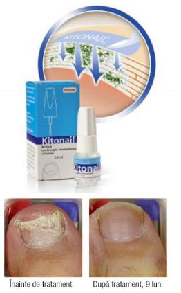 (P) Ramai in forma si scoate micoza unghiei din joc