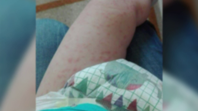 Peste 100 de cazuri noi de rujeolă, în ultimele zile. Care este cel mai afectat judeţ