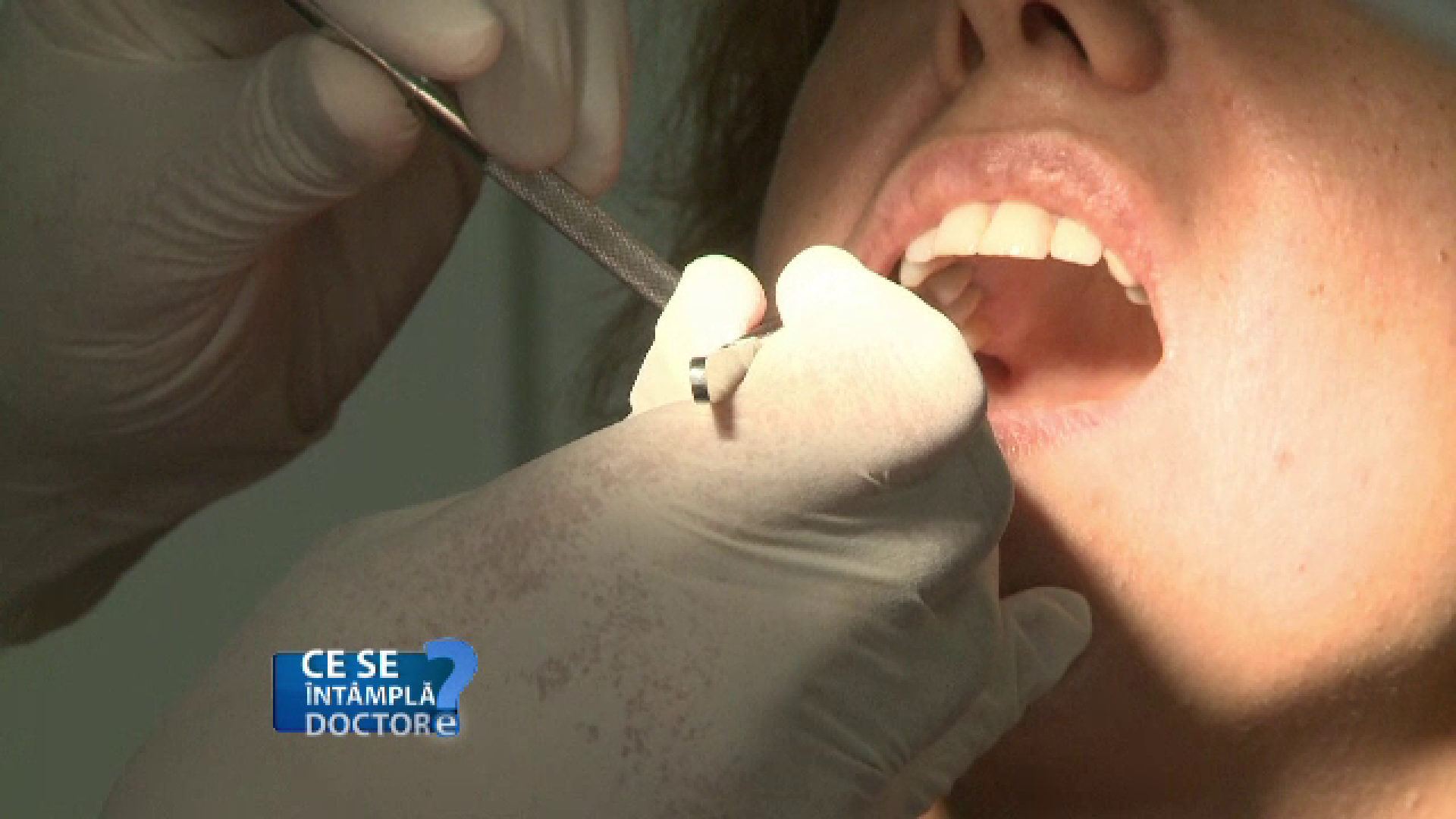 Tartrul, o problema des intalnita care poate conduce la probleme parodontale. Cum se poate indeparta corect