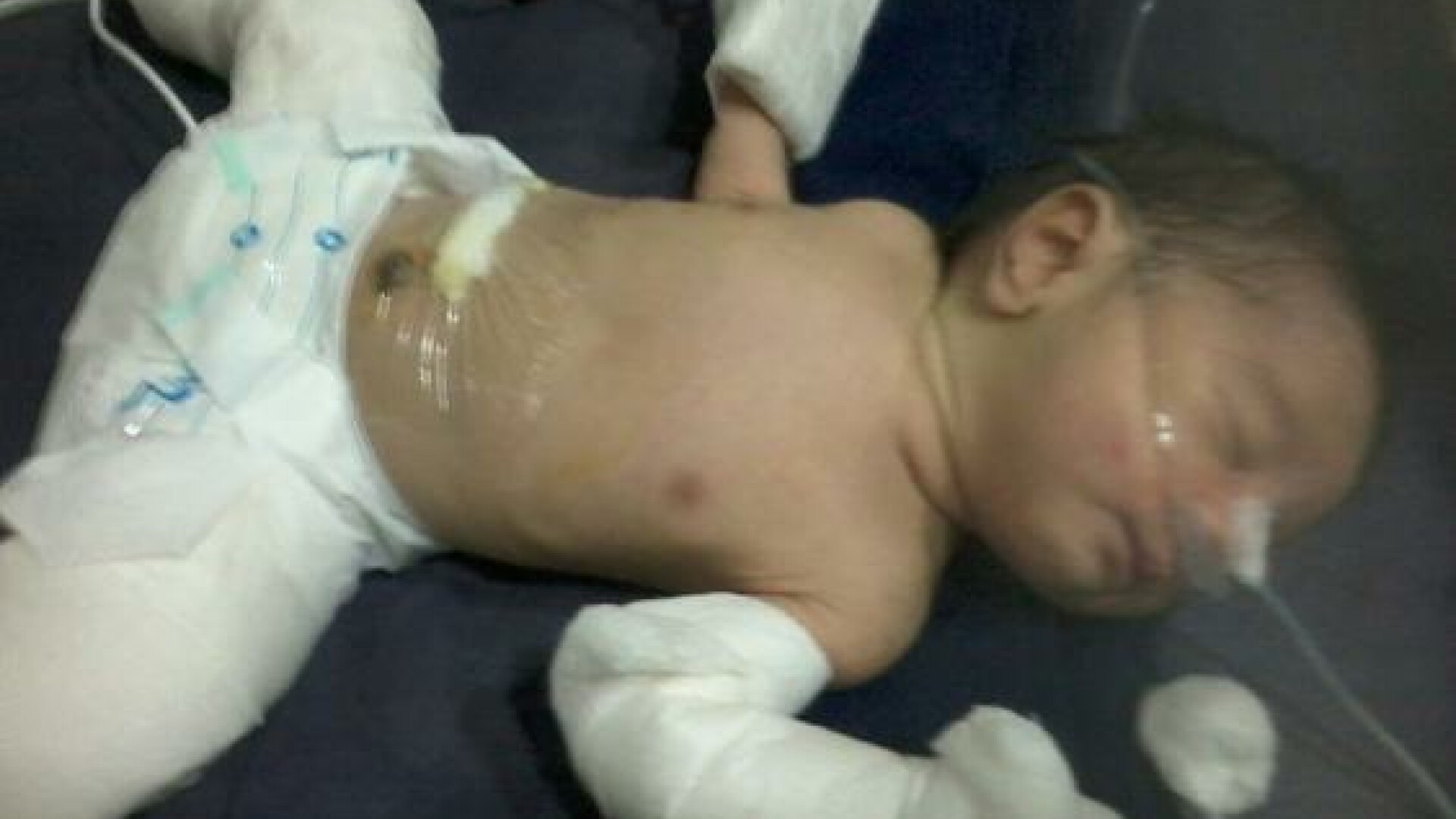 Caz extrem de rar în lumea medicală. Un bebeluş s-a născut "însărcinat" cu geamănul său