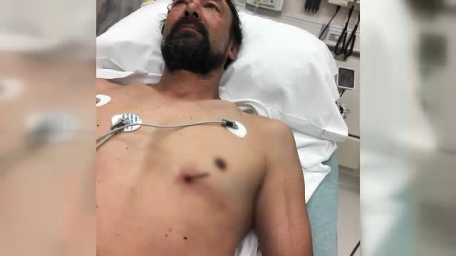 Bărbatul care și-a înfipt un cui în inimă și a supraviețuit