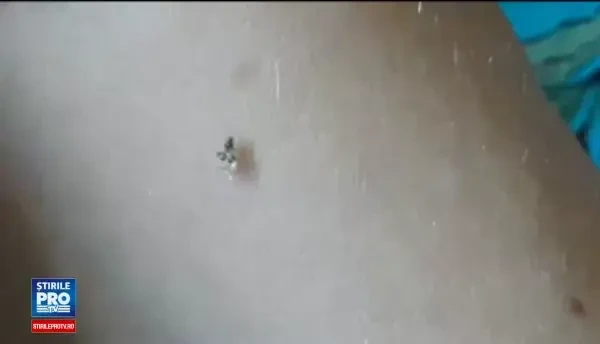 ”Tigrul platanului” a invadat Capitala. Ce spun medicii despre mușcătura insectei