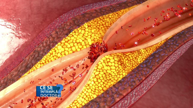 Cum poate fi rezolvată problema arterelor astupate printr-o intervenție fără anestezie