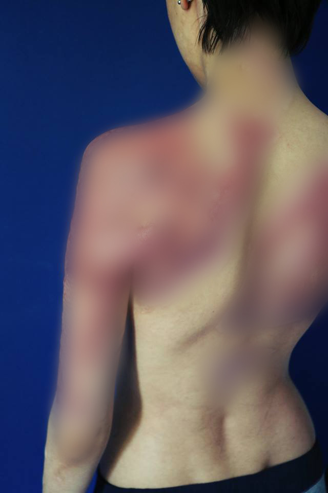 Supravieţuitoare din Colectiv: „Daţi-le marilor arşi şansa pe care ne-aţi refuzat-o. Nu îi lăsaţi şi pe ei să moară”