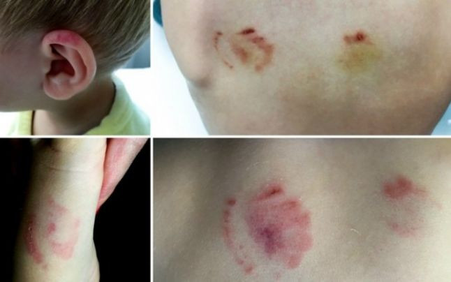 Caz tulburător la Arad. Doi părinți susțin că băiețelul lor a venit mușcat de la grădiniță