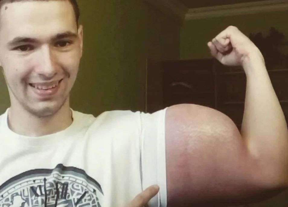 S-a injectat cu o substanță controversată pentru a avea bicepși de 60 de cm
