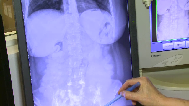 Greşelile comise de brazilienii prinşi cu 2 kg de cocaină în stomac, pe Aeroportul Henri Coandă