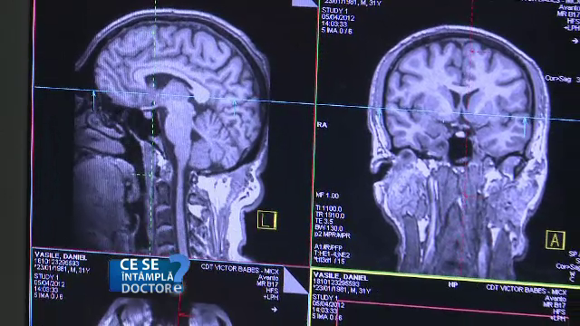 Afecțiunea creierului care distruge viața oamenilor. Cum ne putem feri de ea