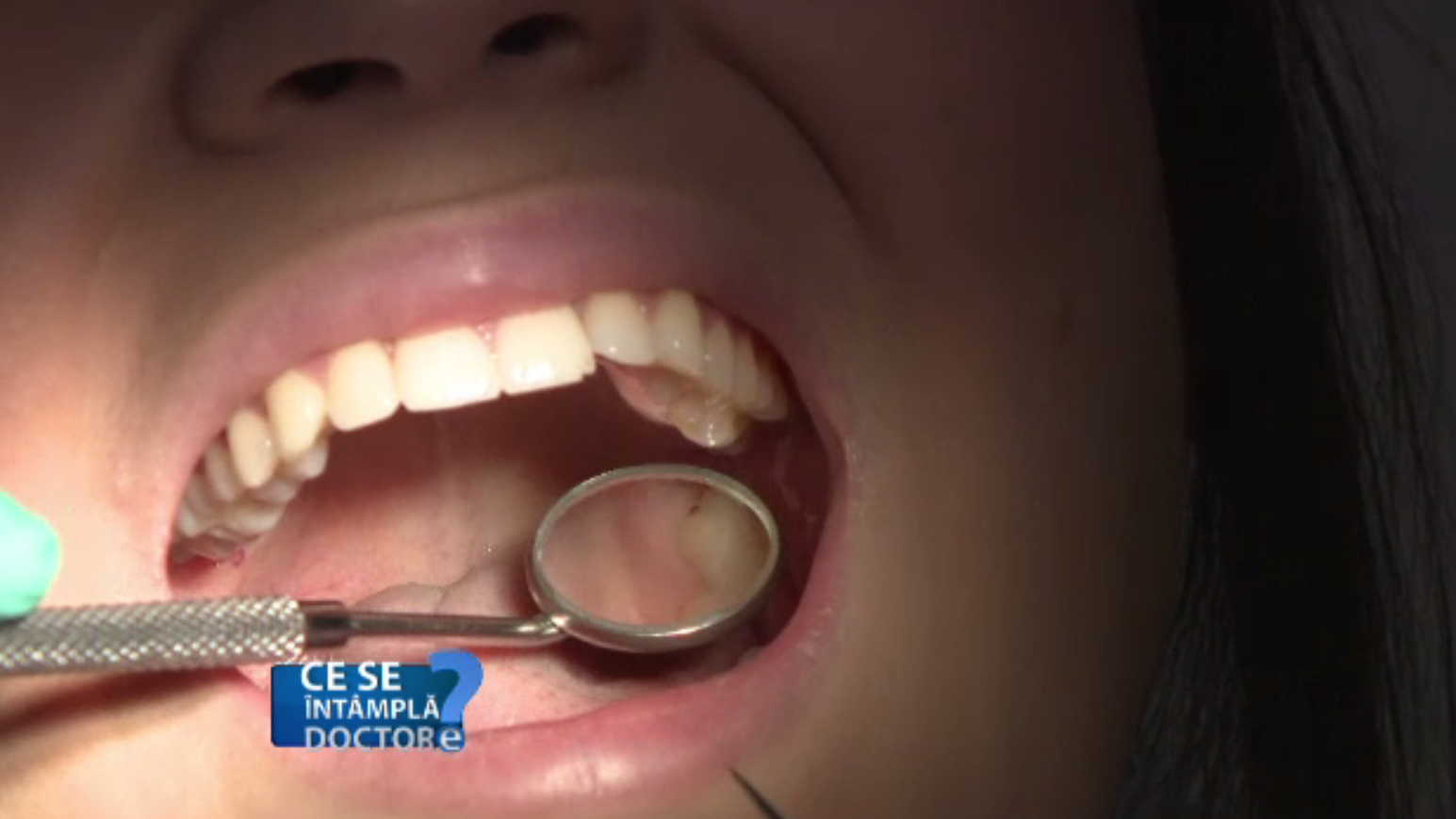 CSID. De ce este indicat să facem un detartraj măcar o dată pe an