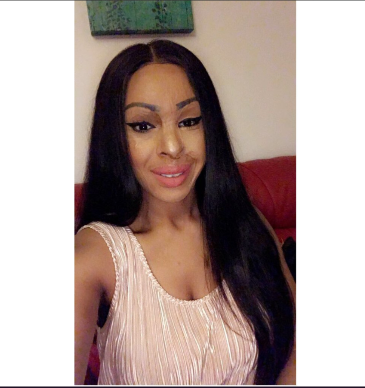 Victima unui atac cu acid rupe tăcerea despre agresoarea sa: „Credeam că-mi este prietenă”