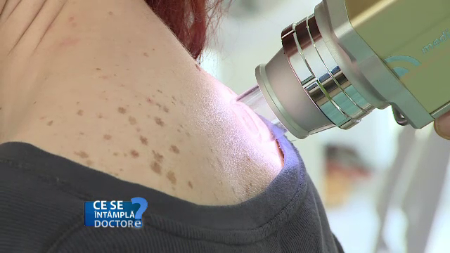 De ce nu este recomandat să ignorăm alunițele și petele apărute pe piele