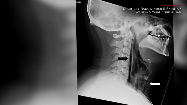 Ce a pățit un bărbat care a încercat să nu strănute