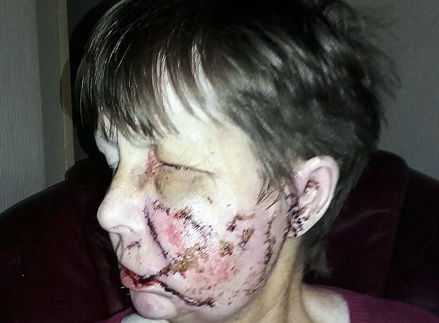 Femeie desfigurată de câinele violent al vecinilor. Fratele ei nu a recunoscut-o în urma atacului