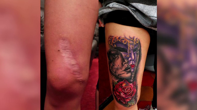 tatuaje posttraumatice