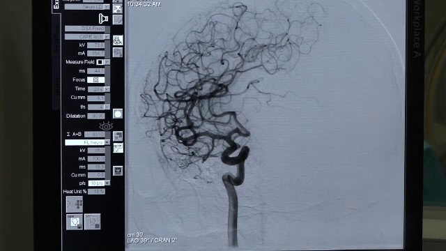 Intervenţie în premieră în România: o pacientă cu 7 anevrisme cerebrale a primit o nouă șansă la viață
