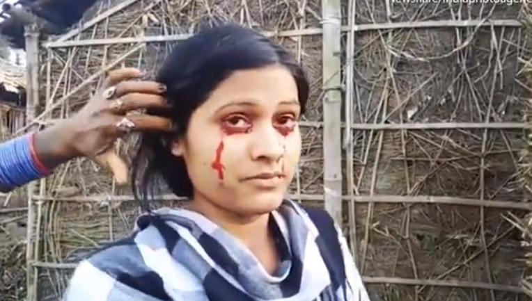 O tânără din India transpiră sânge prin ochi. Soțul a părăsit-o