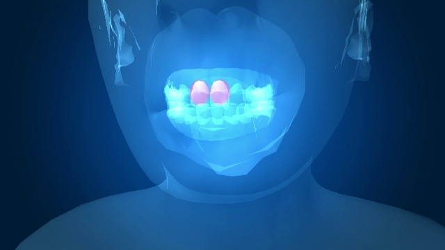 accident, therme, copil, dinti, tobogan,