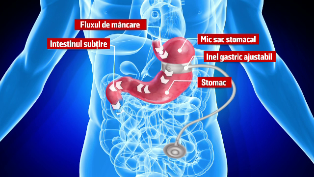 ANIMAȚIE GRAFICĂ. Cum ar fi cedat organismul Israelei Vodovoz din cauza ruperii inelului gastric