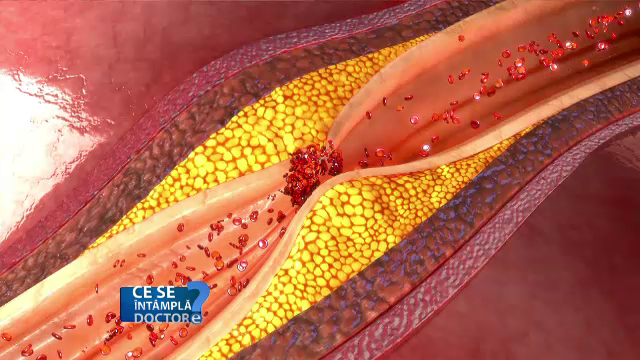 Gudronul din ţigări favorizează depunerile plăcilor de grăsime în interiorul vaselor de sânge
