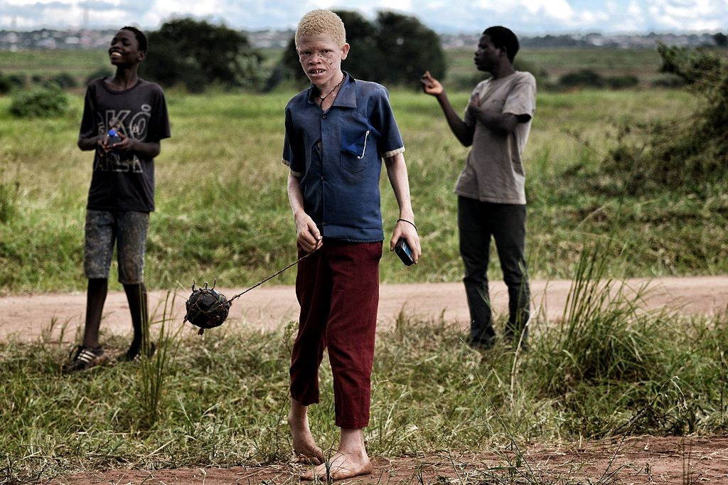 Albinos ucis în Malawi pentru un ritual magic. Poliţia i-ar fi ajutat pe criminali