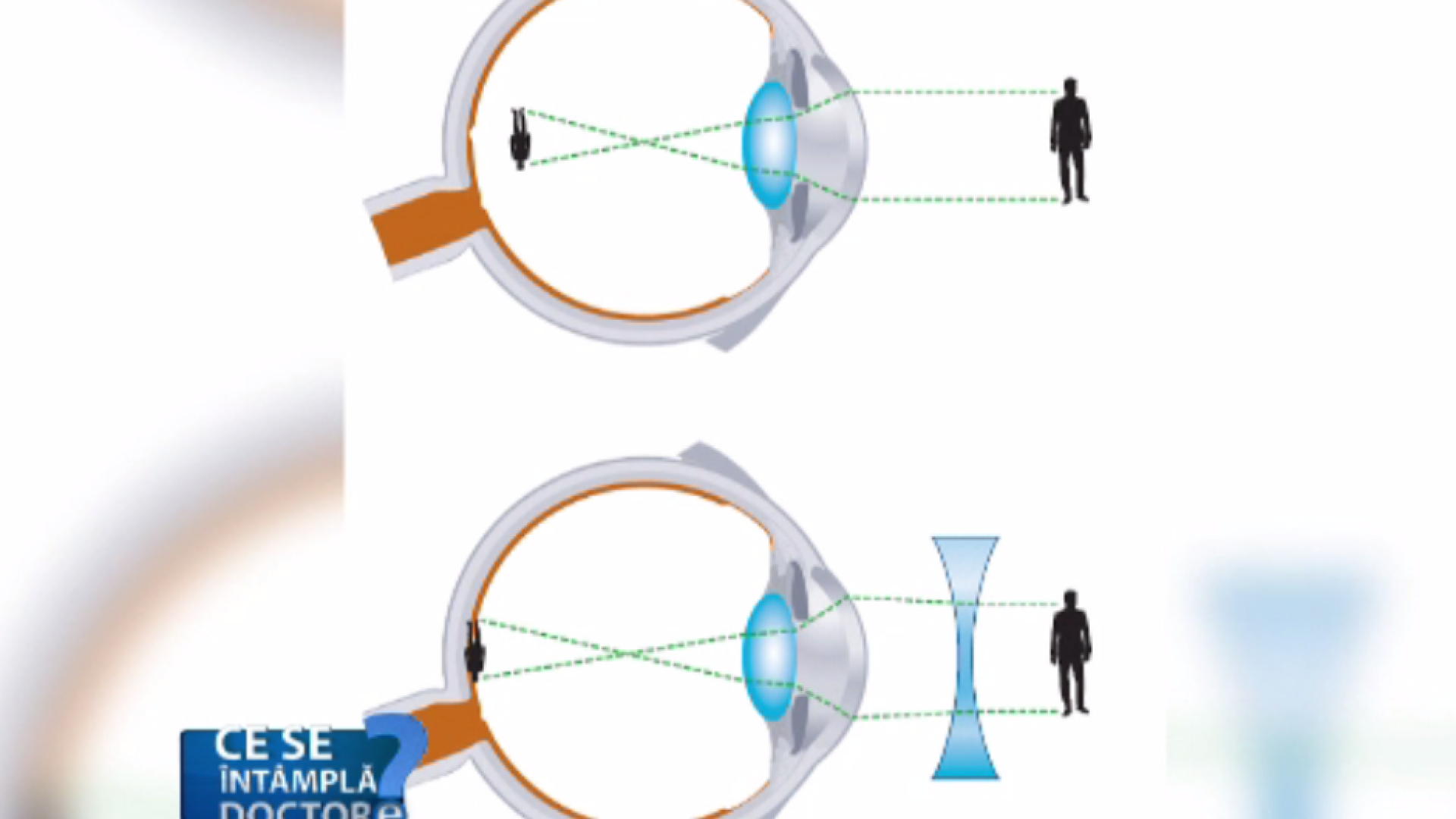Vizita la oftalmolog, obligatorie o dată pe an până la 20 de ani