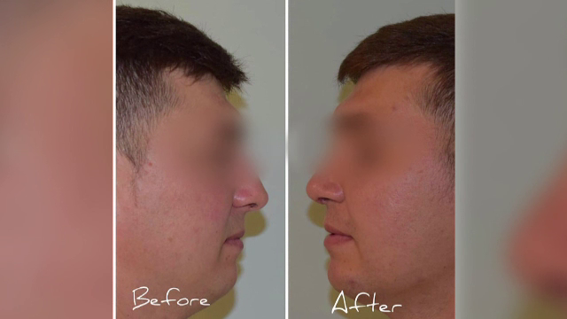 Bărbaţii români apelează la medicii esteticieni. Schimbările dorite de domnii trecuţi de 40 de ani