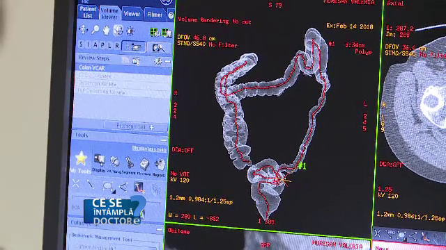 Colonoscopia de control, recomandată persoanelor care trec de 50 de ani