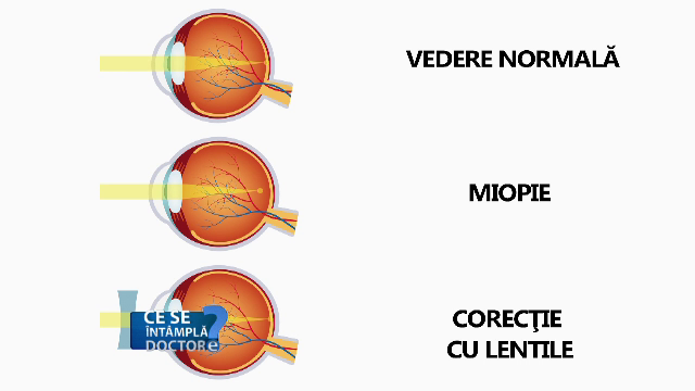Dacă ați fost diagnosticați cu miopie, testați-vă și pentru glaucom