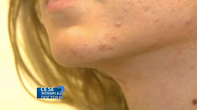 Inflamaţie, noduli, puroi, toate determinate de o banală acnee. Cum o tratăm