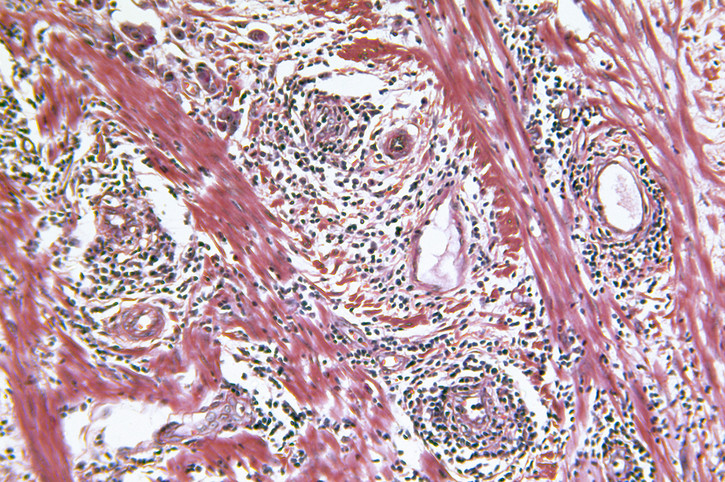 O fetiţă a ajuns să aibă ouă de viermi în creier după ce a mâncat fructe nespălate