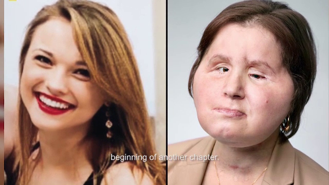 Cel mai tânăr pacient care a primit un transplant de față. A vrut să se sinucidă