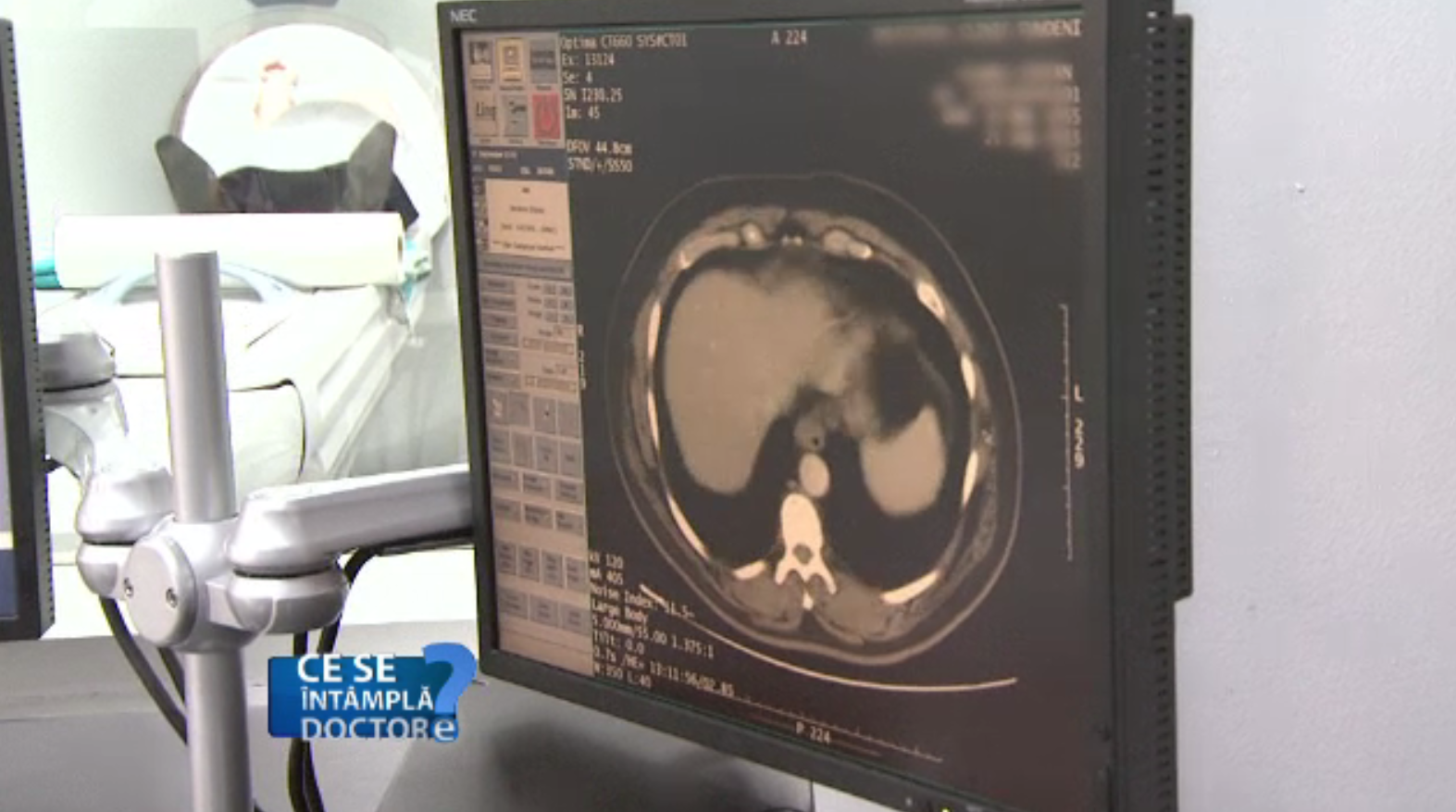 Ce înseamnă obezitate de tip central în formă de măr și cum ne afectează