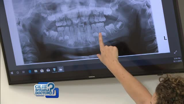 Radiografia dentară NU crește riscul de cancer. Explicația medicilor specialiști