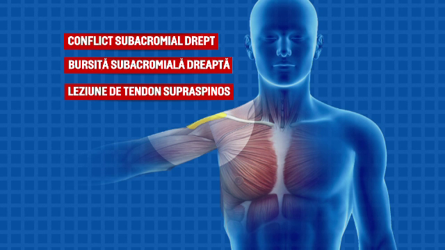 ANIMAȚIE. În ce a constat operația suferită de Klaus Iohannis la umărul stâng