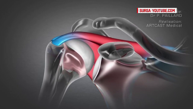 Klaus IOhannis, intervenție chirurgicală