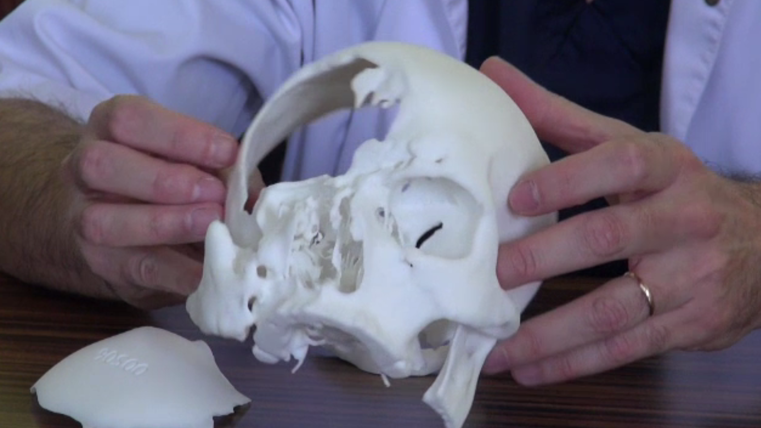 Premieră în Bacău. Medicii au reușit să reconstruiască parțial craniul unui tânăr