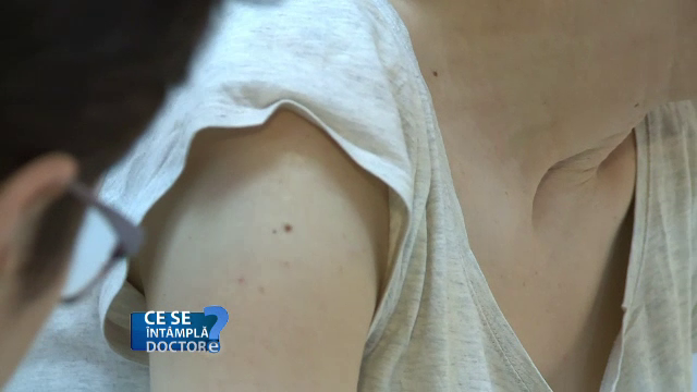 Ce sunt angioamele și de ce trebuie ținute sub observația unui medic dermatolog