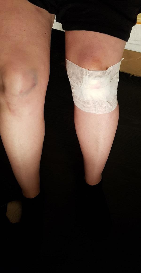 Medicii din Cluj i-au pus carton în loc de ghips unei femei cu mâna ruptă