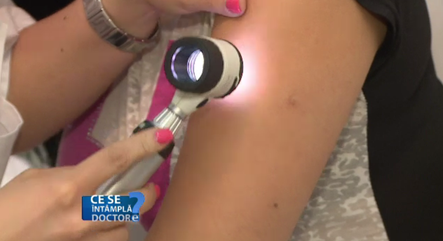 De ce este important să mergeți la medic dacă aveți alunițe pe corp