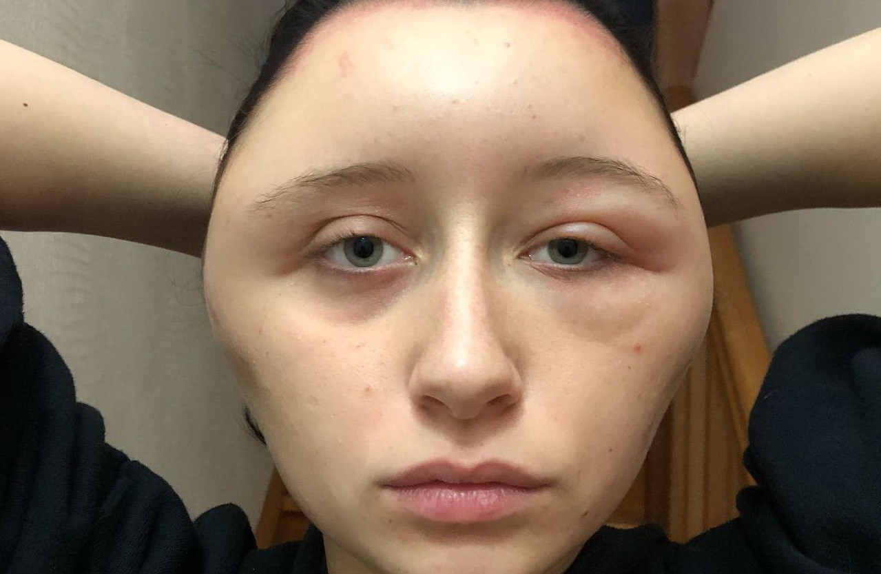 Coșmar pentru o tânără care și-a vopsit părul. A fost la un pas de moarte