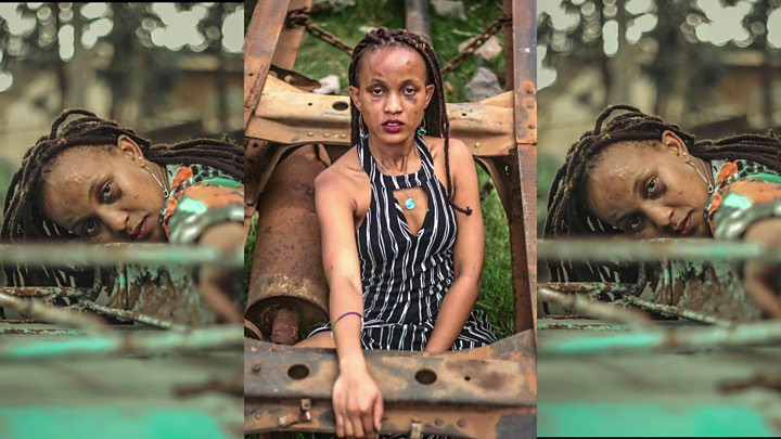 Controversa stârnită de un fotomodel mutilat după un incendiu. De ce a fost acuzată