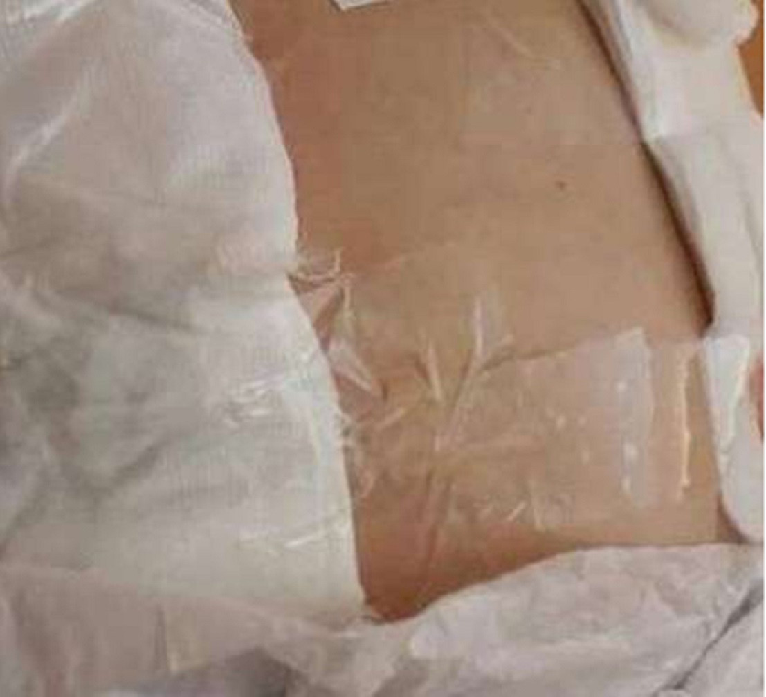 Anchetă la un spital, după ce medicii au lipit cu scotch o pacientă după operaţie