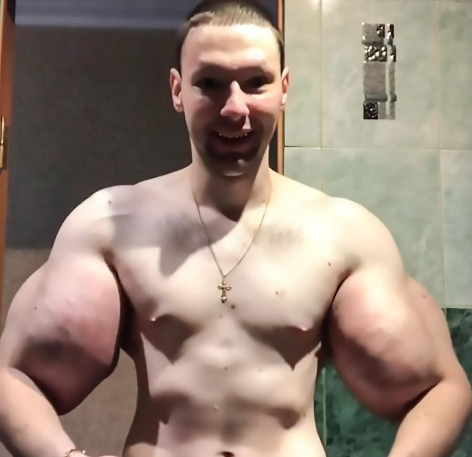 ”Popeye”, tânărul care și-a injectat ulei în brațe, se căsătorește. Cum arată iubita sa